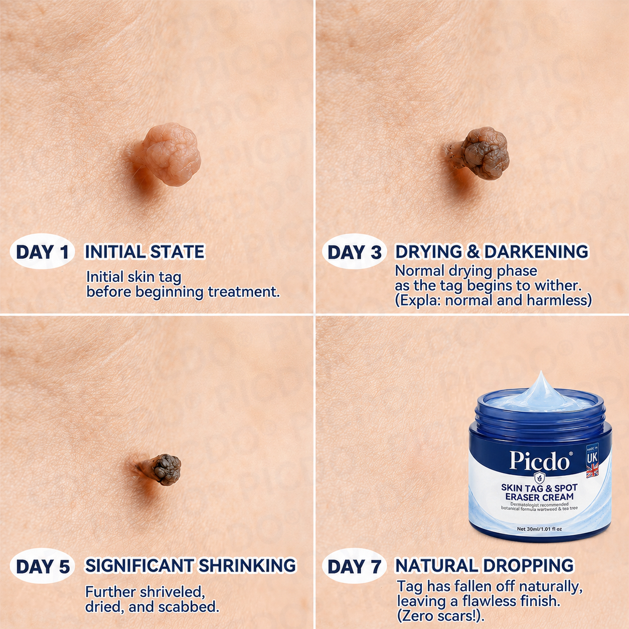 𝐏𝐢𝐜𝐝𝐨® 7-𝐃𝐚𝐲 𝐒𝐤𝐢𝐧 𝐓𝐚𝐠 & 𝐒𝐩𝐨𝐭 𝐄𝐫𝐚𝐬𝐞𝐫 𝐂𝐫𝐞𝐚𝐦 (Zero Pain, Zero 𝐒𝐜𝐚𝐫𝐬 Formula) 🌹