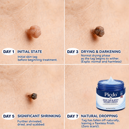 𝐏𝐢𝐜𝐝𝐨® 7-𝐃𝐚𝐲 𝐒𝐤𝐢𝐧 𝐓𝐚𝐠 & 𝐒𝐩𝐨𝐭 𝐄𝐫𝐚𝐬𝐞𝐫 𝐂𝐫𝐞𝐚𝐦 (Zero Pain, Zero 𝐒𝐜𝐚𝐫𝐬 Formula) 🌹