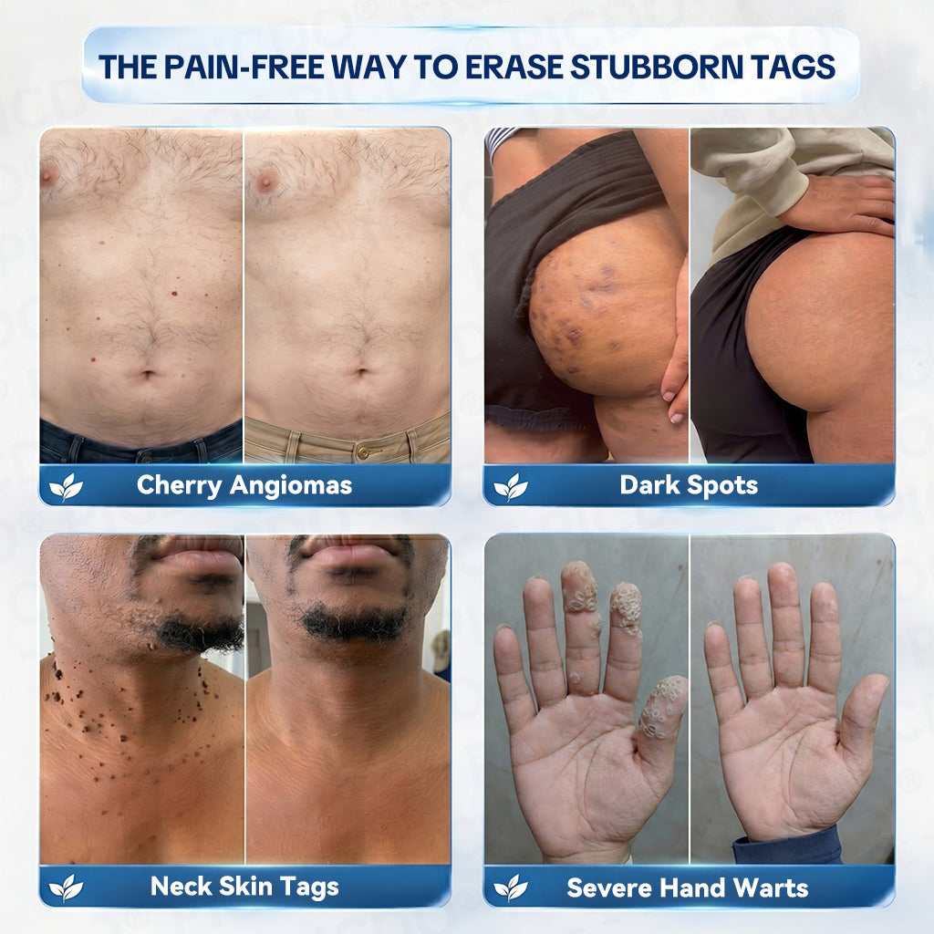 𝐏𝐡𝐚𝐫𝐦𝐚𝐜𝐢𝐬𝐭 𝐑𝐞𝐜𝐨𝐦𝐦𝐞𝐧𝐝𝐞𝐝 ✅𝐏𝐢𝐜𝐝𝐨® 7-𝐃𝐚𝐲 𝐒𝐤𝐢𝐧 𝐓𝐚𝐠 & 𝐒𝐩𝐨𝐭 𝐄𝐫𝐚𝐬𝐞𝐫 𝐂𝐫𝐞𝐚𝐦 🧴(Zero Pain, Zero 𝐒𝐜𝐚𝐫𝐬 Formula)💪