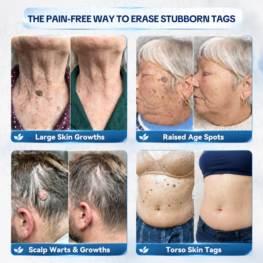 𝐏𝐡𝐚𝐫𝐦𝐚𝐜𝐢𝐬𝐭 𝐑𝐞𝐜𝐨𝐦𝐦𝐞𝐧𝐝𝐞𝐝 ✅𝐏𝐢𝐜𝐝𝐨® 7-𝐃𝐚𝐲 𝐒𝐤𝐢𝐧 𝐓𝐚𝐠 & 𝐒𝐩𝐨𝐭 𝐄𝐫𝐚𝐬𝐞𝐫 𝐂𝐫𝐞𝐚𝐦 🧴(Zero Pain, Zero 𝐒𝐜𝐚𝐫𝐬 Formula)💪