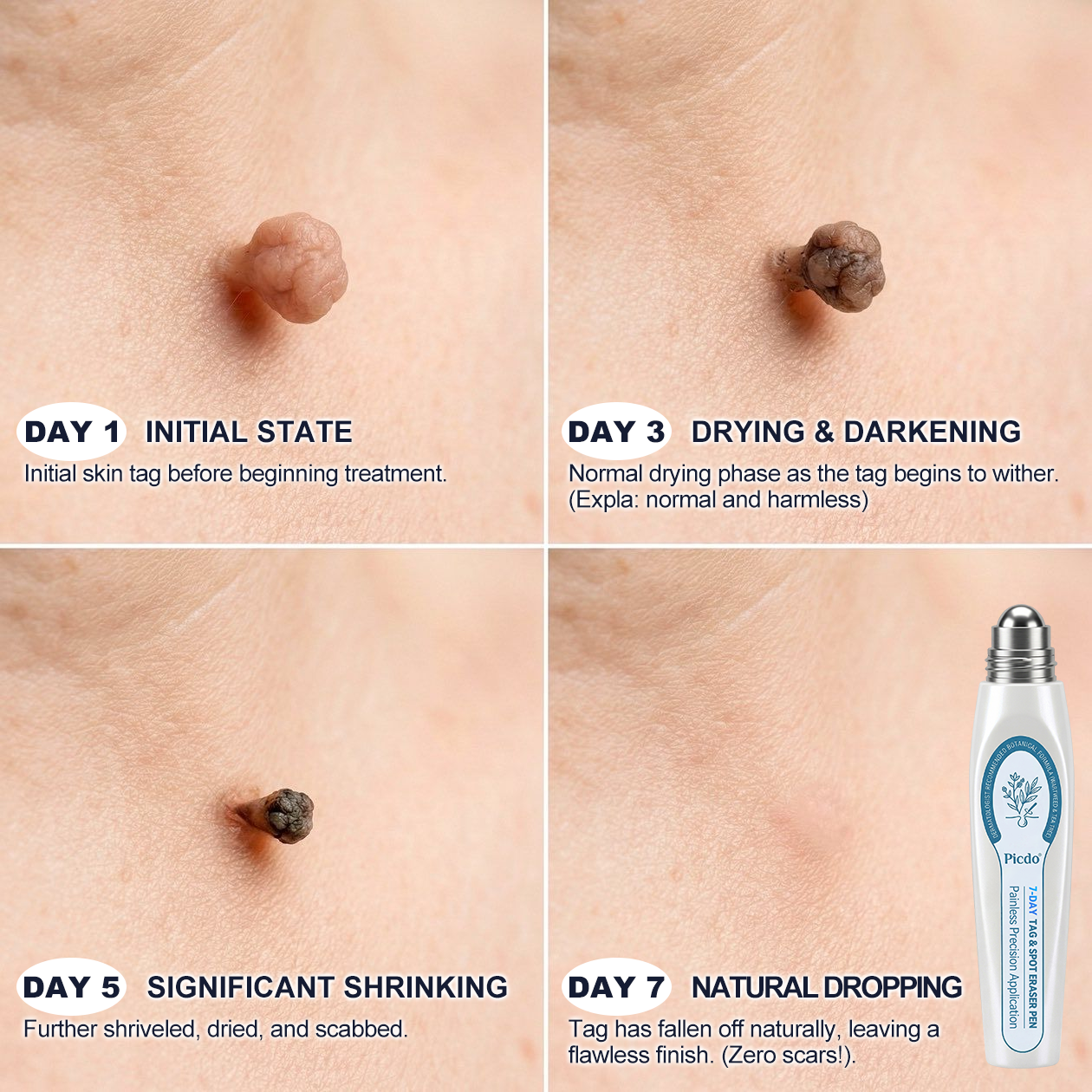 𝐏i𝐜𝐝o® 7-𝐷𝑎𝑦 𝗧𝐚𝐠 & 𝗦𝗽𝐨𝐭 𝐄𝐫𝒂𝒔𝒆𝒓🪄(Zero Pain, Zero 𝐒𝐜𝐚𝒓𝒔 Rollerball)⭐